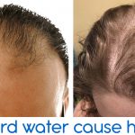 hard water cause hair loss