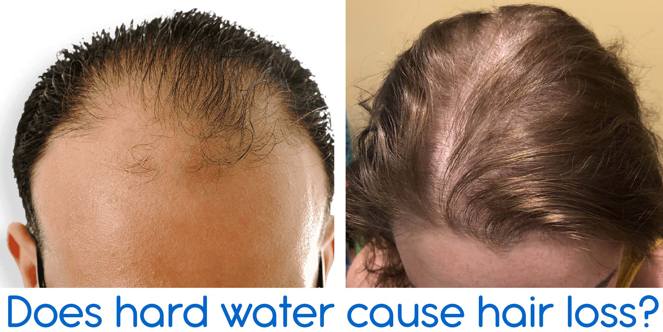 hard water cause hair loss